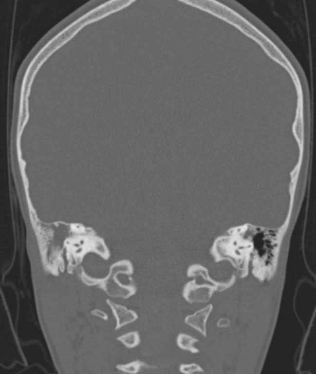 Cerebellar abscess (Radiopaedia 73727-84527 Coronal bone window 48).jpg