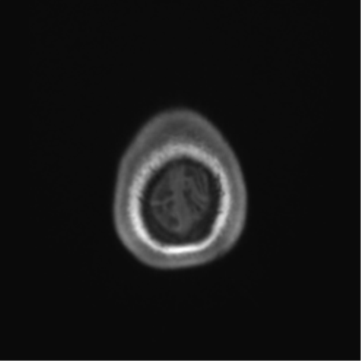 Cerebellar agenesis with hypoplastic pons (pontocerebellar hypoplasia) (Radiopaedia 57224-64138 Axial T1 74).png