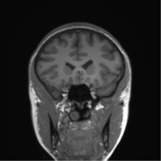 Cerebellar agenesis with hypoplastic pons (pontocerebellar hypoplasia) (Radiopaedia 57224-64138 Coronal T1 64).png