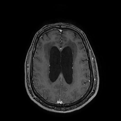 File:Cerebellar hemangioblastoma (Radiopaedia 88055-104622 Axial T1 C+ 121).jpg