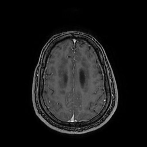 Cerebellar hemangioblastoma (Radiopaedia 88055-104622 Axial T1 C+ 134).jpg