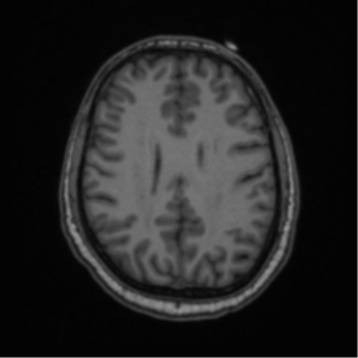 Cerebellar hemangioblastomas and pituitary adenoma (Radiopaedia 85490-101176 Axial T1 49).png