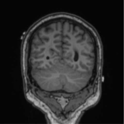 Cerebellar hemangioblastomas and pituitary adenoma (Radiopaedia 85490-101176 Coronal T1 28).png