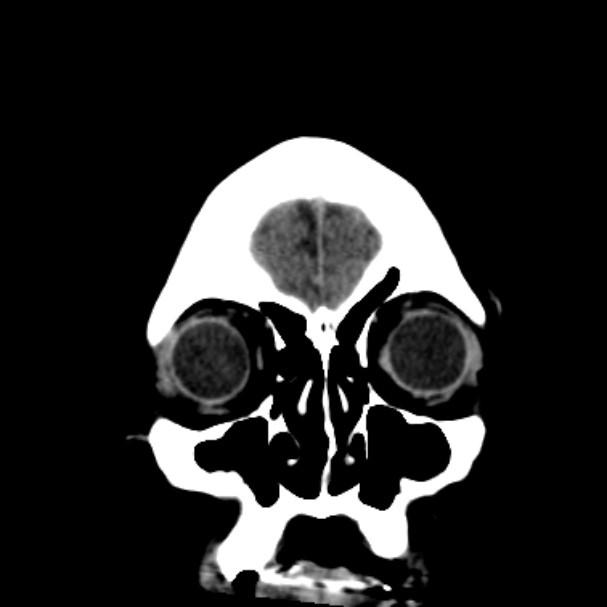 Cerebellar hemorrhage causing obstructive hydrocephalus (Radiopaedia 33989-35207 Coronal non-contrast 9).jpg