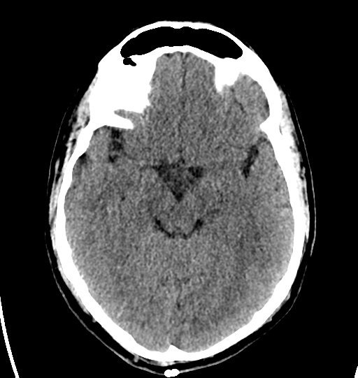 File:Cerebellar infarct due to vertebral artery dissection with posterior fossa decompression (Radiopaedia 82779-97031 Axial non-contrast 13).png