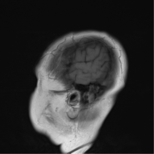 File:Cerebellar metastasis (Radiopaedia 54578-60810 Sagittal T1 1).png