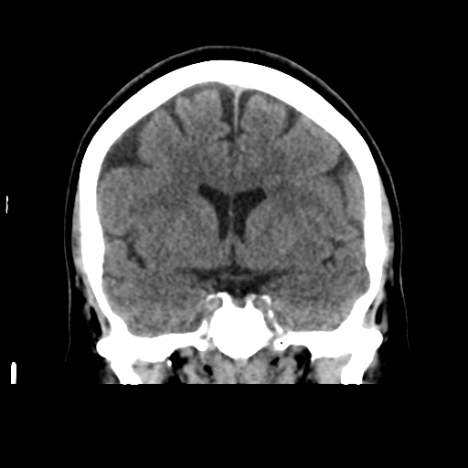 File:Cerebellar metastasis (cystic appearance) (Radiopaedia 41395-44258 Coronal non-contrast 28).png