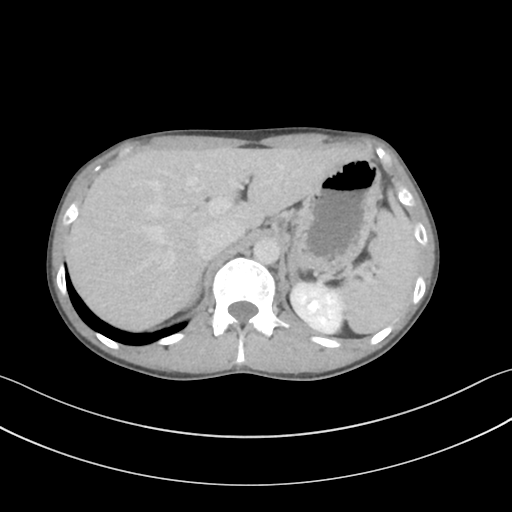 Cerebellar metastasis - adenocarcinoma lung (Radiopaedia 63184-71717 Axial C+ delayed 67).png