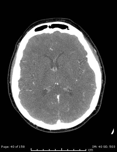 Cerebellar strokes due to intracranial giant cell arteritis (Radiopaedia 68799-78510 CT angiogram 40).jpg