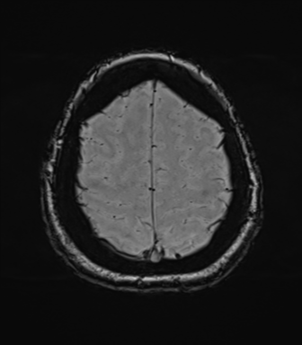 Cerebellopontine angle meningioma (Radiopaedia 48434-53348 Axial SWI 77).png