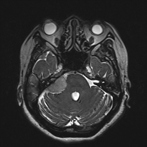 File:Cerebellopontine angle meningioma (Radiopaedia 53561-59591 Axial 3D volume T2 66).jpg