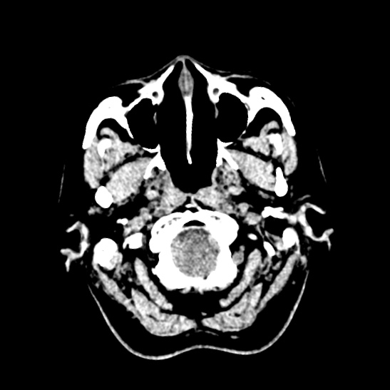 Cerebellopontine angle meningioma (Radiopaedia 53561-59592 Axial non-contrast 6).jpg