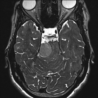 Cerebellopontine angle meningioma (Radiopaedia 72983-83680 Axial FIESTA 52).jpg