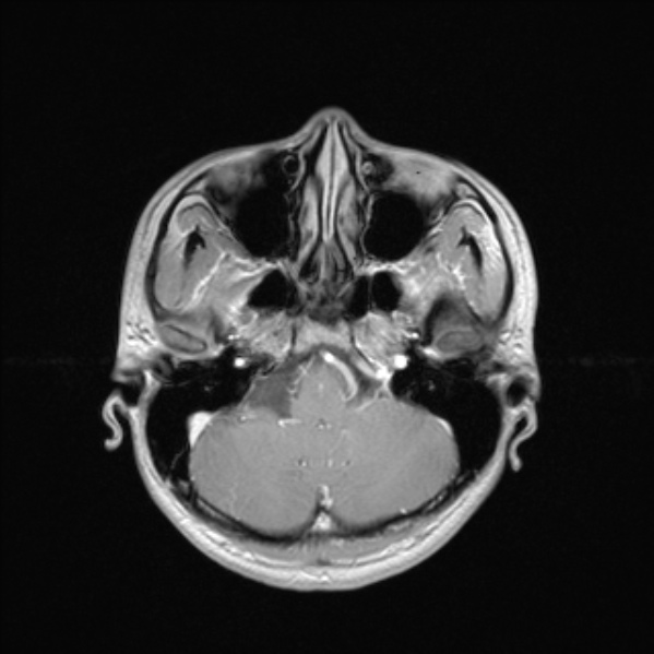 Cerebral abscess (Radiopaedia 24212-24478 Axial T1 C+ 17).jpg