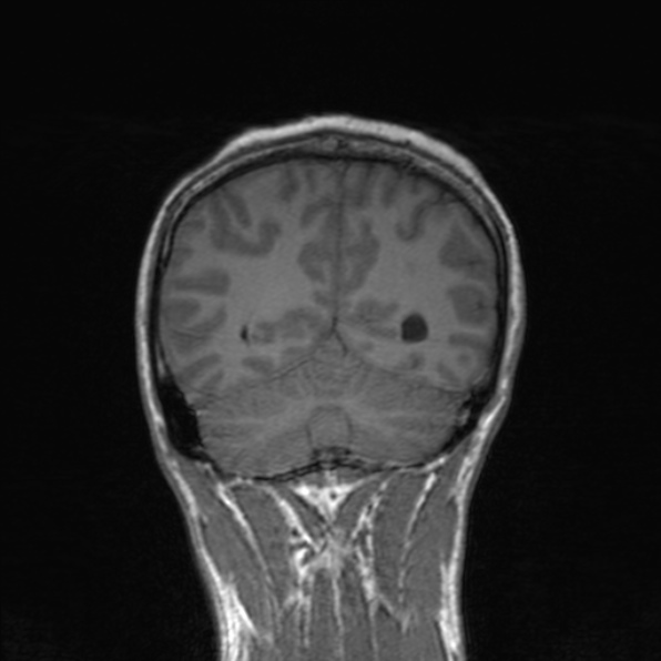 Cerebral abscess (Radiopaedia 24212-24478 Coronal T1 155).jpg