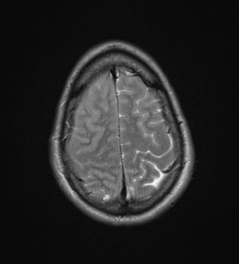 File:Cerebral abscess (Radiopaedia 60342-68009 Axial T2 31).png