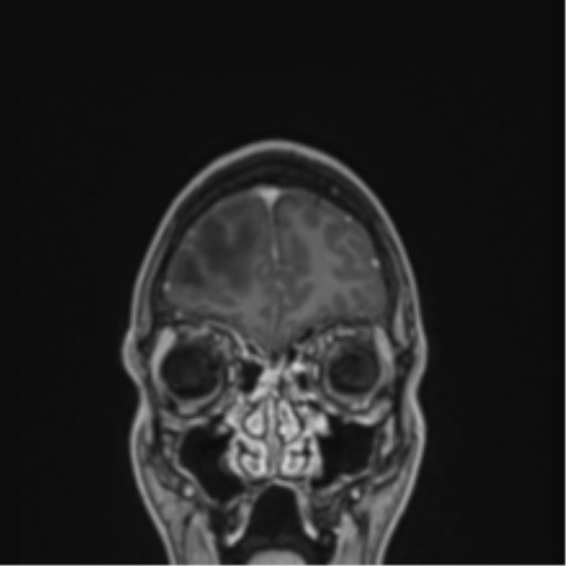 Cerebral abscess (Radiopaedia 60342-68009 H 48).png