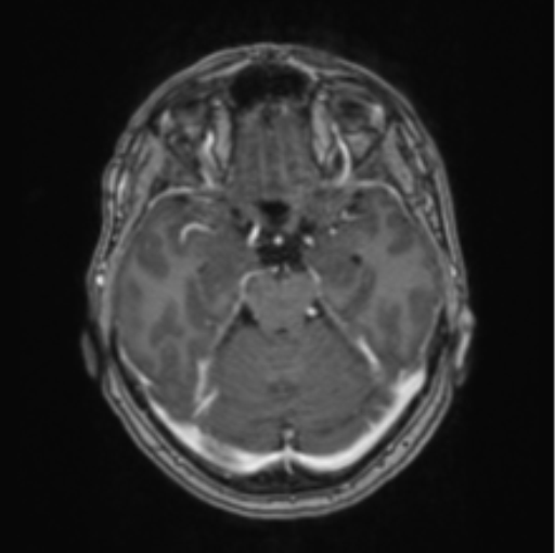 Cerebral abscess from pulmonary arteriovenous malformation (Radiopaedia 86275-102291 Axial T1 C+ 29).png