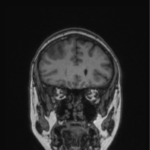 File:Cerebral abscess from pulmonary arteriovenous malformation (Radiopaedia 86275-102291 Coronal T1 66).png