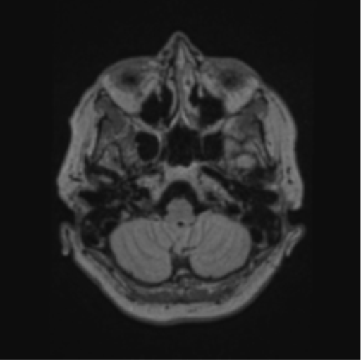 File:Cerebral abscess from pulmonary arteriovenous malformation (Radiopaedia 86275-102291 J 17).png