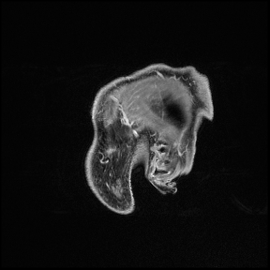 Cerebral abscess with ventriculitis (Radiopaedia 78965-91878 Sagittal T1 C+ 12).jpg