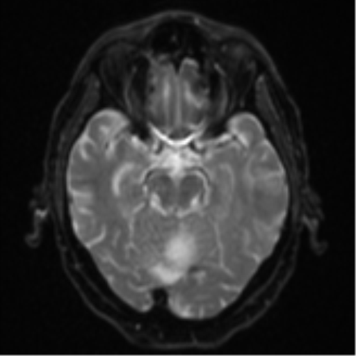 Cerebral abscesses- medically managed (Radiopaedia 45183-49179 Axial DWI 11).png