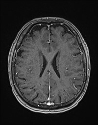 Cerebral amyloid angiopathy-related inflammation (Radiopaedia 58270-65377 Axial T1 C+ fat sat 93).jpg