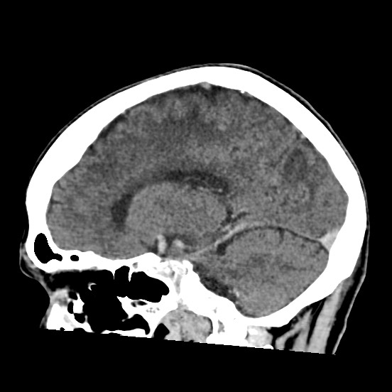 Cerebral amyloid angiopathy-related inflammation (Radiopaedia 74836-85848 C 36).jpg