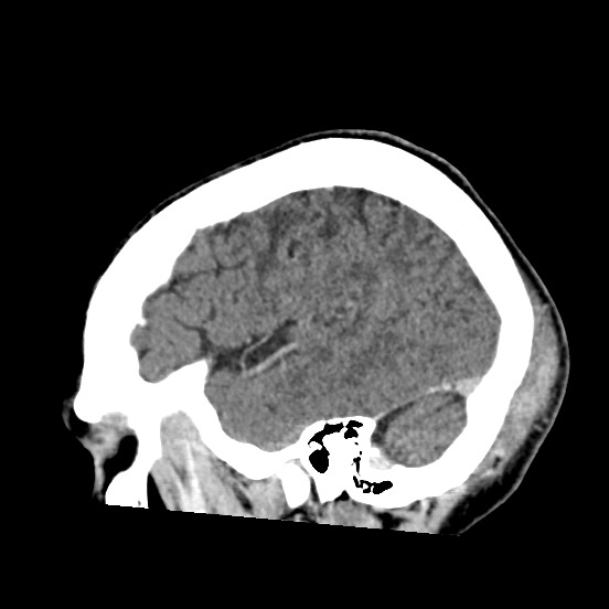Cerebral amyloid angiopathy-related inflammation (Radiopaedia 74836-85848 C 48).jpg