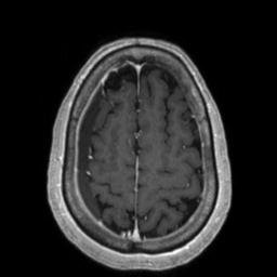 Cerebral amyloid angiopathy (Radiopaedia 29129-29518 Axial T1 C+ 121).jpg
