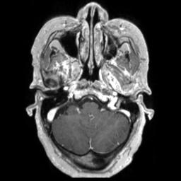 Cerebral amyloid angiopathy (Radiopaedia 29129-29518 Axial T1 C+ 32).jpg