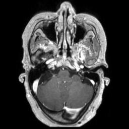Cerebral amyloid angiopathy (Radiopaedia 29129-29518 Axial T1 C+ 36).jpg