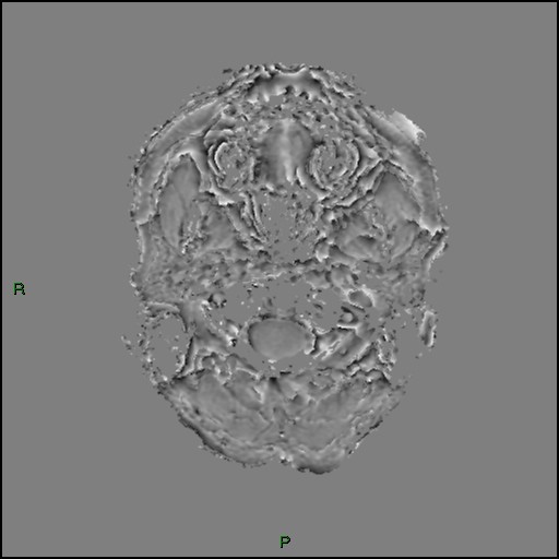 Cerebral amyloid angiopathy (Radiopaedia 77506-89664 H 2).jpg
