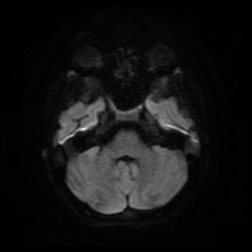 File:Cerebral and spinal tuberculosis (Radiopaedia 90489-107837 Axial DWI 7).jpg