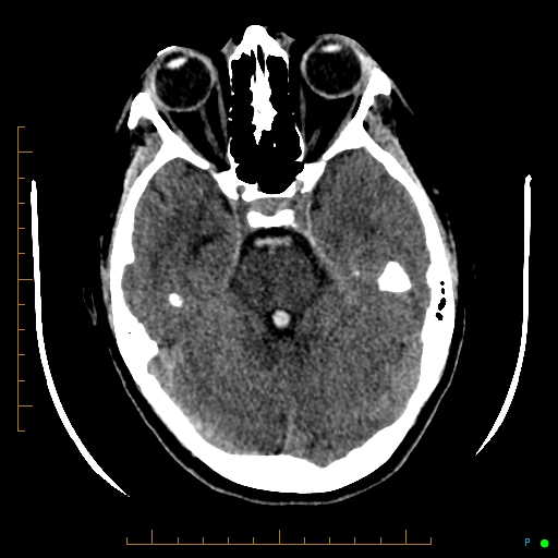 Cerebral arteriovenous malformation (AVM) (Radiopaedia 78162-90706 Axial non-contrast 22).jpg