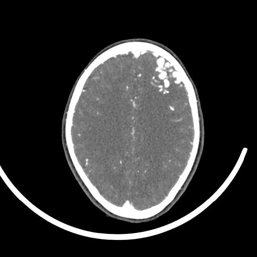 Cerebral arteriovenous malformation (Radiopaedia 29531-30031 E 81).jpg