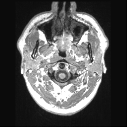 Cerebral arteriovenous malformation (Radiopaedia 39259-41506 Axial T1 2).png