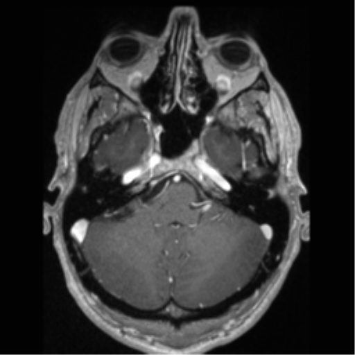 Cerebral arteriovenous malformation (Radiopaedia 55798-62372 Axial T1 C+ 16).png