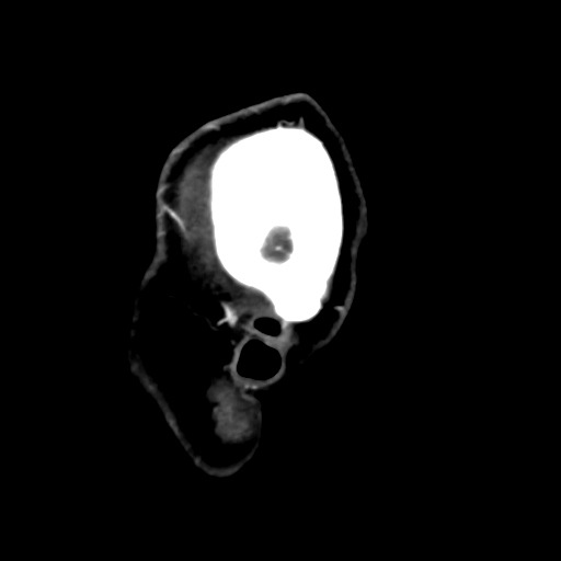 Cerebral arteriovenous malformation (Radiopaedia 73830-84645 Sagittal C+ delayed 88).jpg