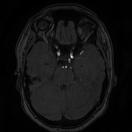 Cerebral arteriovenous malformation (Radiopaedia 74411-85654 Axial MRA 37).jpg