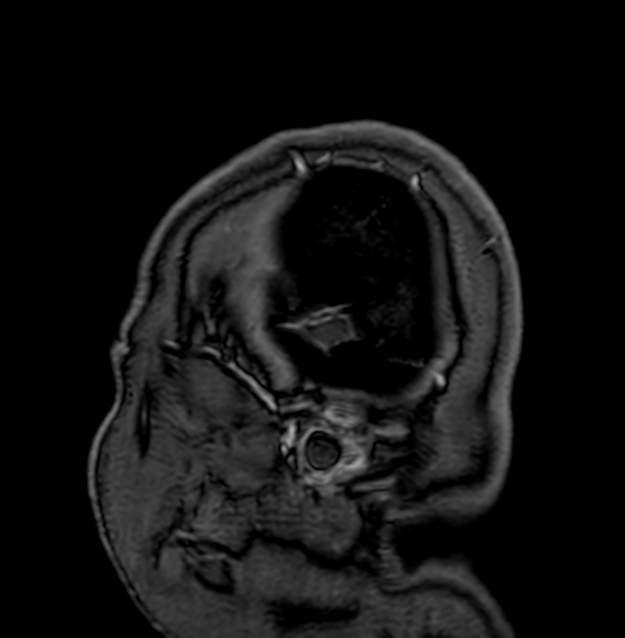 Cerebral arteriovenous malformation (Radiopaedia 74411-85746 Sagittal T1 C+ 1).jpg
