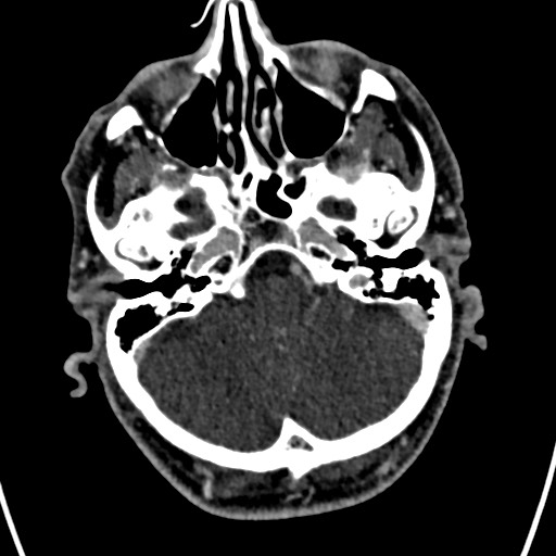Cerebral arteriovenous malformation (Radiopaedia 78188-90746 Axial C+ delayed 35).jpg