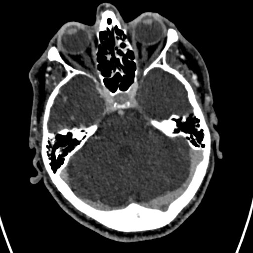 Cerebral arteriovenous malformation (Radiopaedia 78188-90746 Axial C+ delayed 51).jpg