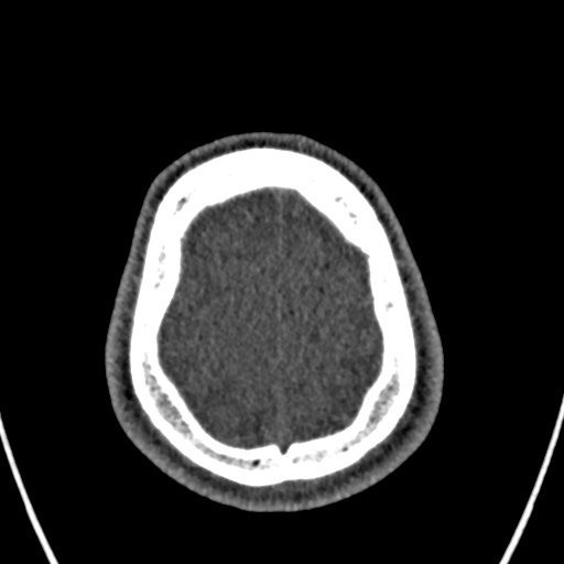 Cerebral arteriovenous malformation (Radiopaedia 78188-90746 Axial non-contrast 159).jpg