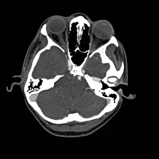 File:Cerebral arteriovenous malformation (Radiopaedia 79677-92888 A 8).jpg