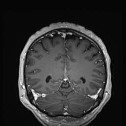 Cerebral arteriovenous malformation (Radiopaedia 84015-99245 Coronal T1 C+ 121).jpg