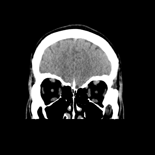 Cerebral arteriovenous malformation (Spetzler-Martin grade 2) (Radiopaedia 41262-44076 Coronal non-contrast 12).png