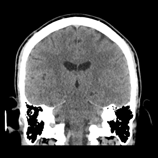 File:Cerebral arteriovenous malformation (Spetzler-Martin grade 2) (Radiopaedia 41262-44076 Coronal non-contrast 36).png
