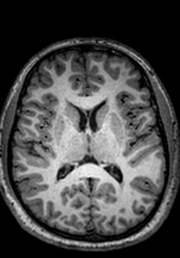 File:Cerebral arteriovenous malformation at posterior body of corpus callosum (Radiopaedia 74111-84925 Axial T1 130).jpg