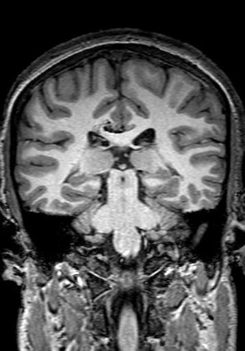 Cerebral arteriovenous malformation at posterior body of corpus callosum (Radiopaedia 74111-84925 Coronal T1 206).jpg